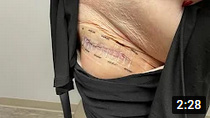 1 Week Follow Up Direct Anterior Hip Replacement with Bikini Incision Doing Great