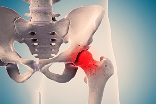 The 5 Key Benefits of Direct Anterior Hip Replacement