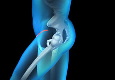 Bikini Incision anterior hip replacement