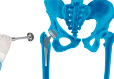 Mako Robotic-Arm Assisted  Total Hip Replacement